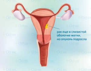 рак эндометрия-2