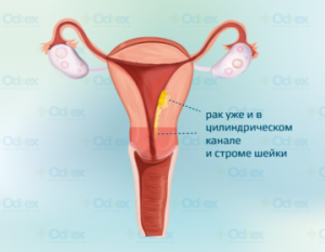 рак эндометрия-3