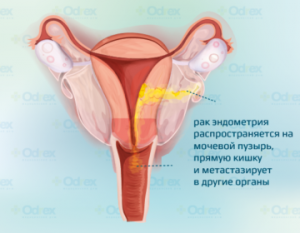 рак эндометрия-4