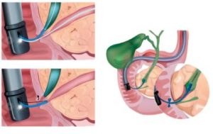 Эндоскопическая папиллосфинктеротомия (ЭПСТ)