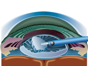 Факоэмульсификация
