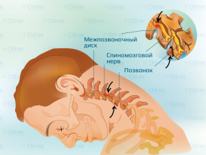 шейный остеохондроз