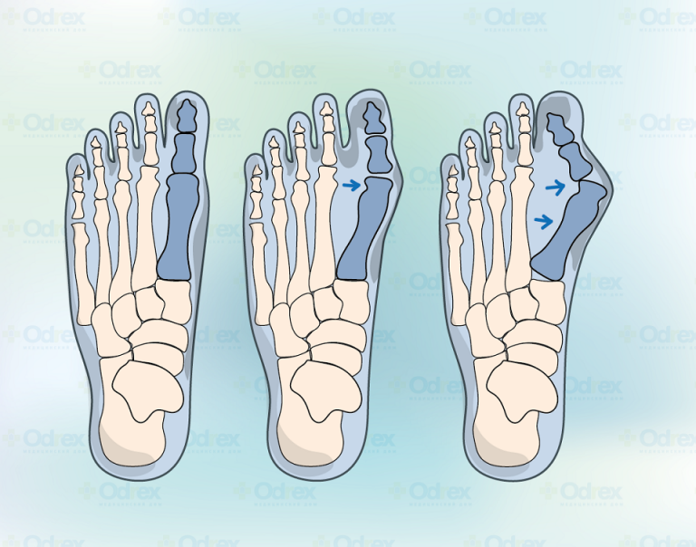 Тейпирование халюс вальгус схема