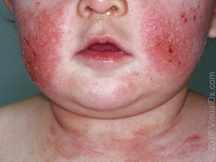 Экзематозный дерматит у детей фото