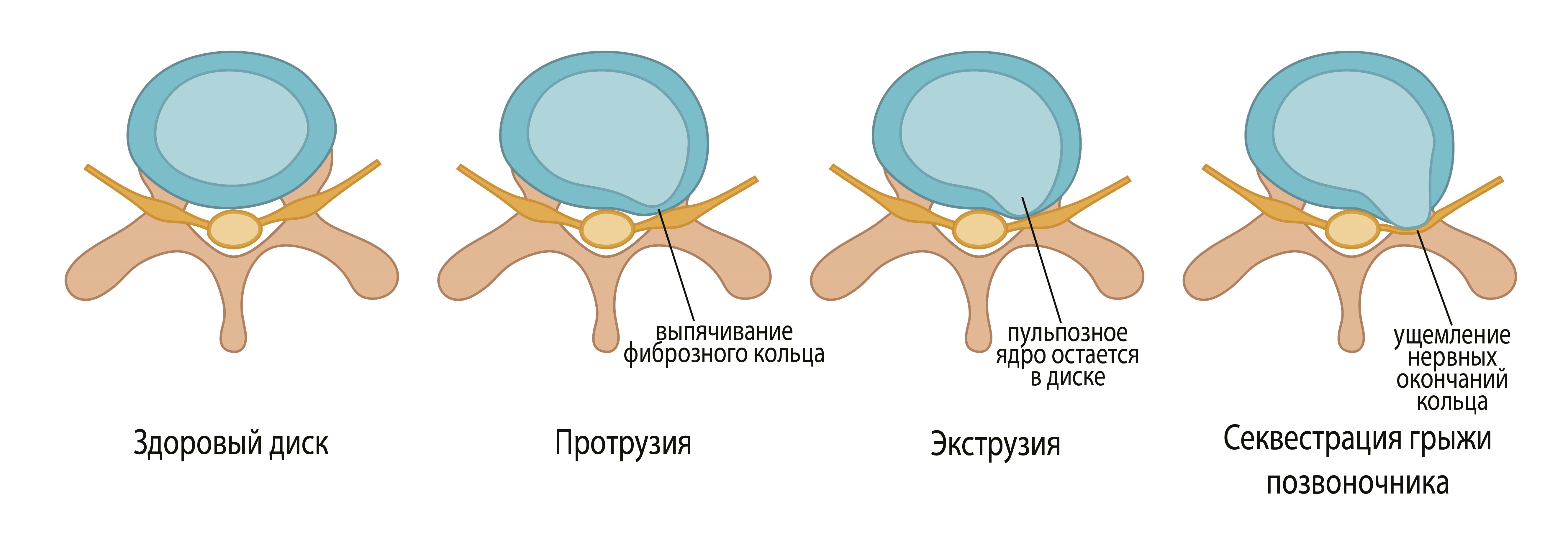 Спасаем позвоночник | Медицинский дом Odrex